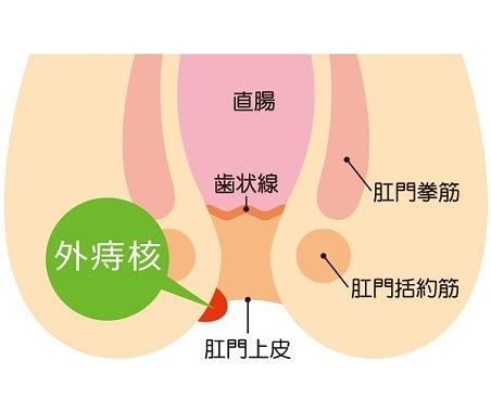 外痔核