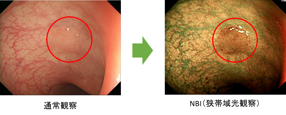 特殊光(NBI）による詳細な内視鏡診断
