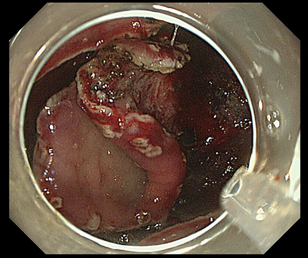 胃ESD治療中の画像