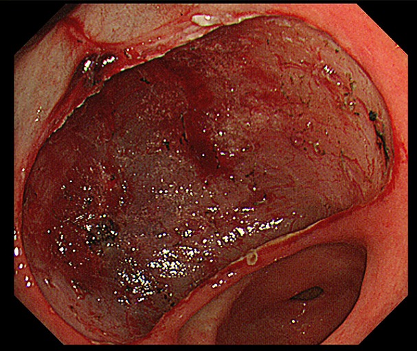 胃ESD治療直後の画像