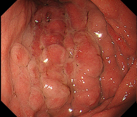 胃がん 初期 症状 スキルス 初期症状～癌発見まで